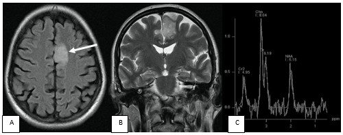 Paciente de 14 años con historia previa de epilepsia