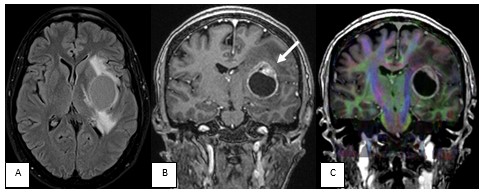 Paciente de 56 años con cáncer de mama y una metástasis cerebral