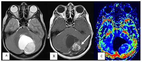 Paciente de 6 años de edad con diagnóstico de tumor de cerebelo